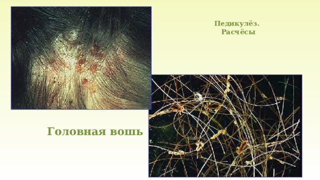 Педикулёз.  Расчёсы Головная вошь 