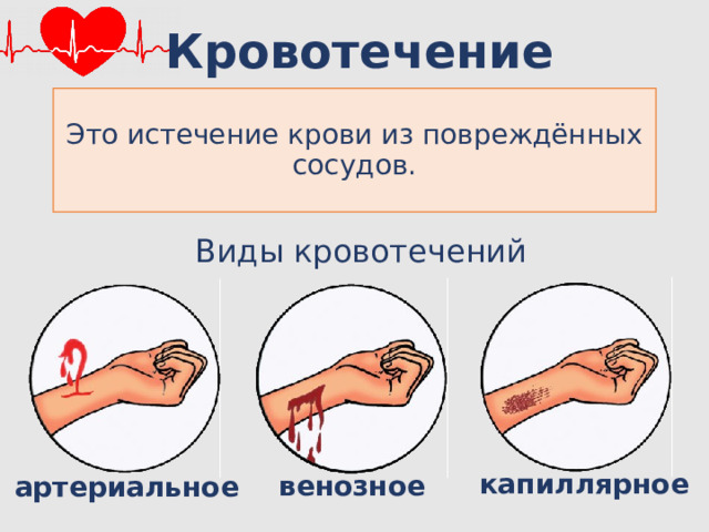 Кровотечение Это истечение крови из повреждённых сосудов. Виды кровотечений капиллярное венозное артериальное 10 
