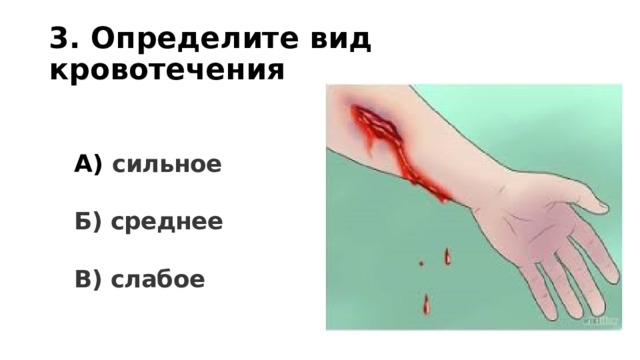 3. Определите вид кровотечения А) сильное  Б) среднее  В) слабое 