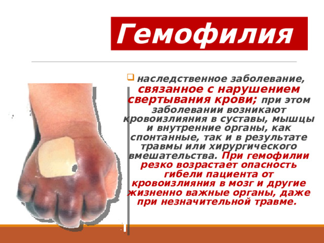 Гемофилия наследственное заболевание, связанное с нарушением свертывания крови; при этом заболевании возникают кровоизлияния в суставы, мышцы и внутренние органы, как спонтанные, так и в результате травмы или хирургического вмешательства. При гемофилии резко возрастает опасность гибели пациента от кровоизлияния в мозг и другие жизненно важные органы, даже при незначительной травме. 