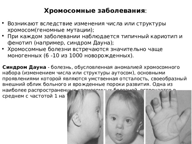 Хромосомные  заболевания : Возникают вследствие изменения числа или структуры хромосом(геномные мутации); При каждом заболевании наблюдается типичный кариотип и фенотип (например, синдром Дауна); Хромосомные болезни встречаются значительно чаще моногенных (6 -10 из 1000 новорожденных). Синдром Дауна - болезнь, обусловленная аномалией хромосомного набора (изменением числа или структуры аутосом), основными проявлениями которой являются умственная отсталость, своеобразный внешний облик больного и врожденные пороки развития. Одна из наиболее распространенных хромосомных болезней, встречается в среднем с частотой 1 на 700 новорожденных. 