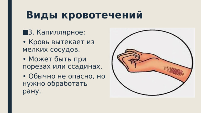  Виды кровотечений 3. Капиллярное: • Кровь вытекает из мелких сосудов. • Может быть при порезах или ссадинах. • Обычно не опасно, но нужно обработать рану.   