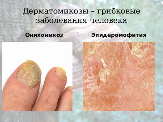 Дерматомикозы – грибковые заболевания человека Онихомикоз Эпидеромофития 