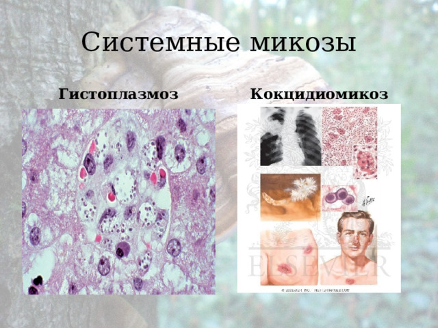 Системные микозы Гистоплазмоз Кокцидиомикоз 