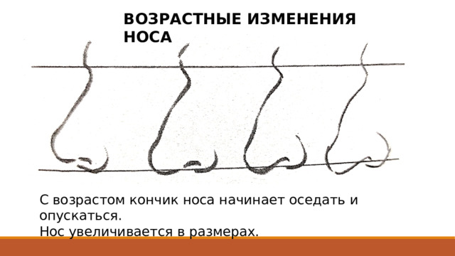 ВОЗРАСТНЫЕ ИЗМЕНЕНИЯ НОСА С возрастом кончик носа начинает оседать и опускаться. Нос увеличивается в размерах. 