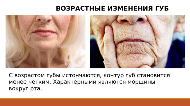 ВОЗРАСТНЫЕ ИЗМЕНЕНИЯ ГУБ С возрастом губы истончаются, контур губ становится менее четким. Характерными являются морщины вокруг рта. 