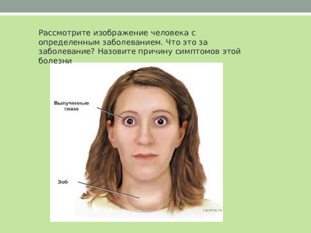 Рассмотрите изображение человека с определенным заболеванием. Что это за заболевание? Назовите причину симптомов этой болезни 