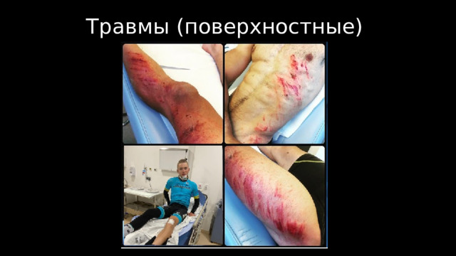Травмы (поверхностные) 