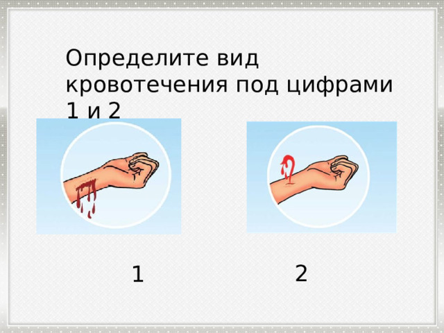 Определите вид кровотечения под цифрами 1 и 2 2 1 