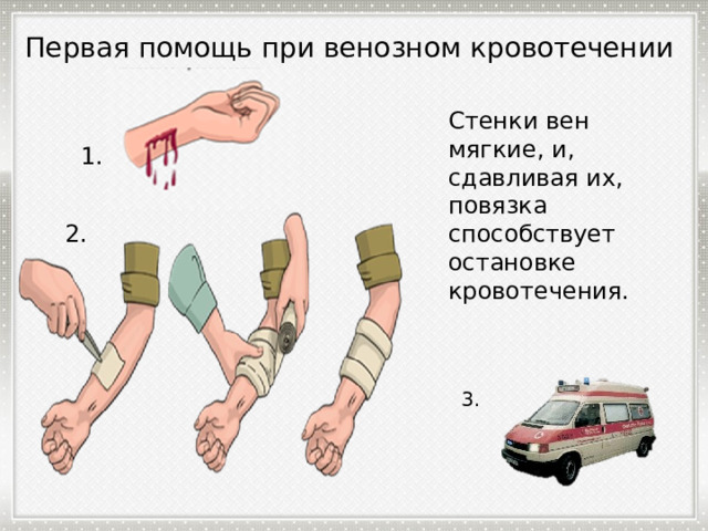 Первая помощь при венозном кровотечении Стенки вен мягкие, и, сдавливая их, повязка способствует остановке кровотечения. 1. 2. 3. 