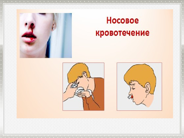 Носовое кровотечение 