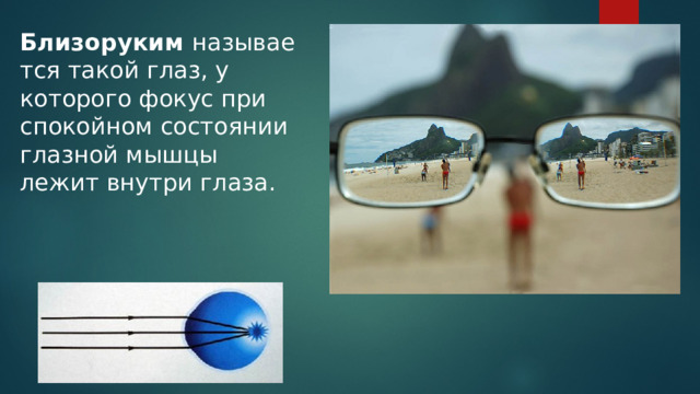 Близоруким  называется такой глаз, у которого фокус при спокойном состоянии глазной мышцы лежит внутри глаза. 