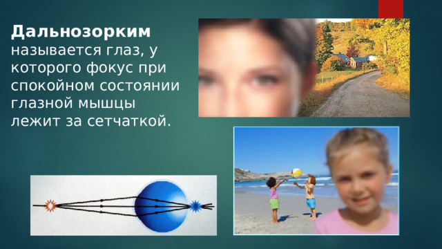 Дальнозорким называется глаз, у которого фокус при спокойном состоянии глазной мышцы лежит за сетчаткой. 