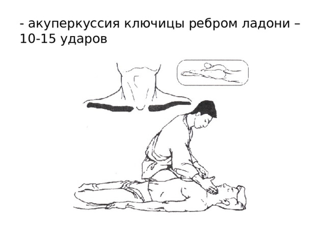 - акуперкуссия ключицы ребром ладони – 10-15 ударов 