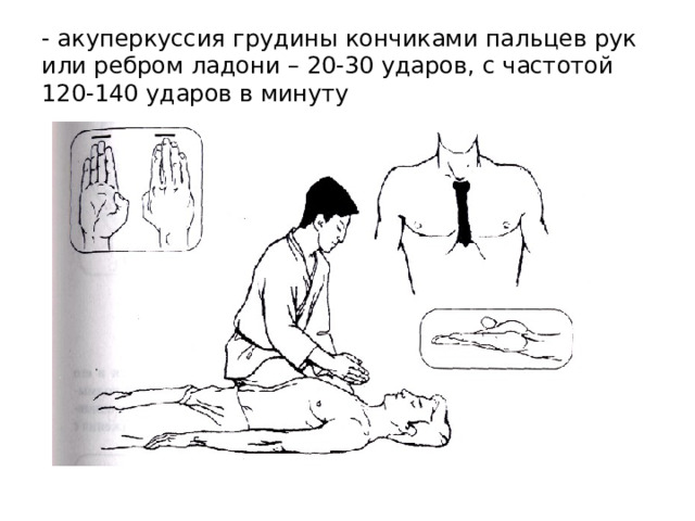- акуперкуссия грудины кончиками пальцев рук или ребром ладони – 20-30 ударов, с частотой 120-140 ударов в минуту 