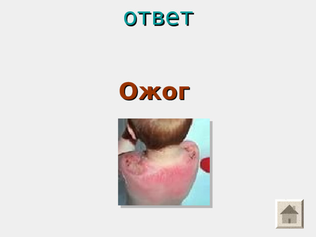 ответ    Ожог 