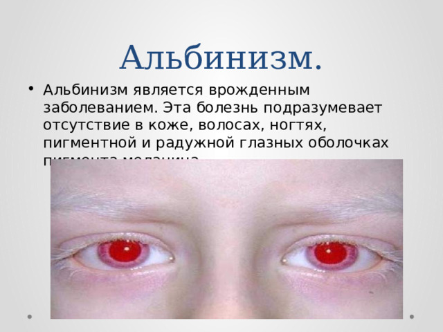 Альбинизм. Альбинизм является врожденным заболеванием. Эта болезнь подразумевает отсутствие в коже, волосах, ногтях, пигментной и радужной глазных оболочках пигмента меланина . 