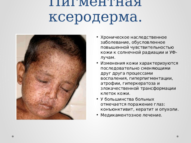 Пигментная ксеродерма. Хроническое наследственное заболевание, обусловленное повышенной чувствительностью кожи к солнечной радиации и УФ-лучам. Изменения кожи характеризуются последовательно сменяющими друг друга процессами воспаления, гиперпигментации, атрофии, гиперкератоза и злокачественной трансформации клеток кожи. У большинства больных отмечается поражение глаз: конъюнктивит, кератит и опухоли. Медикаментозное лечение. 