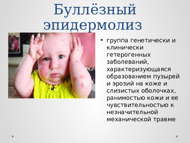 Буллёзный эпидермолиз группа генетически и клинически гетерогенных заболеваний, характеризующаяся образованием пузырей и эрозий на коже и слизистых оболочках, ранимостью кожи и ее чувствительностью к незначительной механической травме 