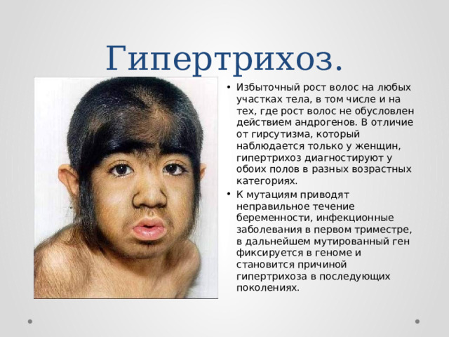 Гипертрихоз. Избыточный рост волос на любых участках тела, в том числе и на тех, где рост волос не обусловлен действием андрогенов. В отличие от гирсутизма, который наблюдается только у женщин, гипертрихоз диагностируют у обоих полов в разных возрастных категориях. К мутациям приводят неправильное течение беременности, инфекционные заболевания в первом триместре, в дальнейшем мутированный ген фиксируется в геноме и становится причиной гипертрихоза в последующих поколениях. 