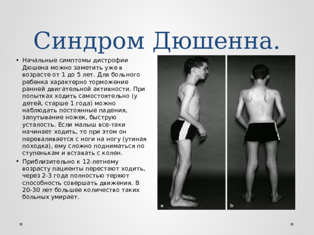 Синдром Дюшенна. Начальные симптомы дистрофии Дюшена можно заметить уже в возрасте от 1 до 5 лет. Для больного ребенка характерно торможение ранней двигательной активности. При попытках ходить самостоятельно (у детей, старше 1 года) можно наблюдать постоянные падения, запутывание ножек, быструю усталость. Если малыш все-таки начинает ходить, то при этом он переваливается с ноги на ногу (утиная походка), ему сложно подниматься по ступенькам и вставать с колен. Приблизительно к 12-летнему возрасту пациенты перестают ходить, через 2-3 года полностью теряют способность совершать движения. В 20-30 лет большее количество таких больных умирает. 