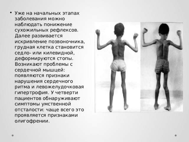 Уже на начальных этапах заболевания можно наблюдать понижение сухожильных рефлексов. Далее развивается искривление позвоночника, грудная клетка становится седло- или килевидной, деформируются стопы. Возникают проблемы с сердечной мышцей: появляются признаки нарушения сердечного ритма и левожелудочковая гипертрофия. У четверти пациентов обнаруживают симптомы умственной отсталости: чаще всего это проявляется признаками олигофрении. 
