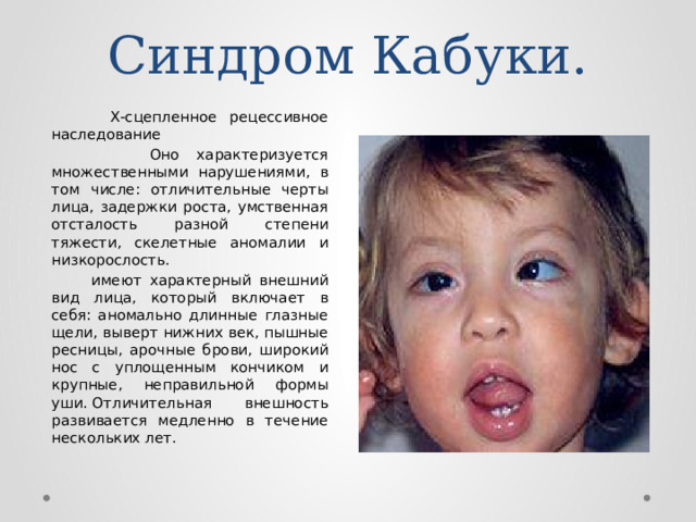 Синдром Кабуки.  X-сцепленное рецессивное наследование   Оно характеризуется множественными нарушениями, в том числе: отличительные черты лица, задержки роста, умственная отсталость разной степени тяжести, скелетные аномалии и низкорослость.   имеют характерный внешний вид лица, который включает в себя: аномально длинные глазные щели, выверт нижних век, пышные ресницы, арочные брови, широкий нос с уплощенным кончиком и крупные, неправильной формы уши. Отличительная внешность развивается медленно в течение нескольких лет. 