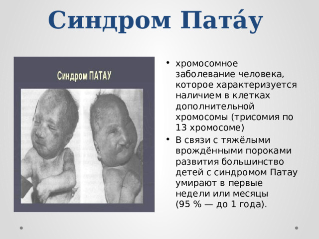 Синдром Пата́у   хромосомное заболевание человека, которое характеризуется наличием в клетках дополнительной хромосомы (трисомия по 13 хромосоме) В связи с тяжёлыми врождёнными пороками развития большинство детей с синдромом Патау умирают в первые недели или месяцы (95 % — до 1 года). 