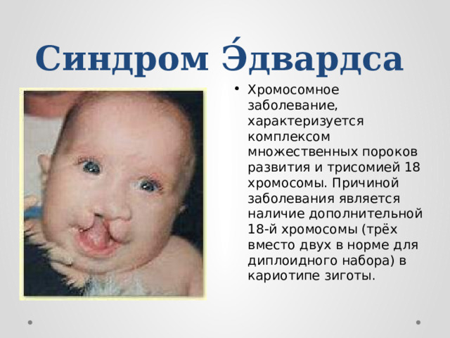Синдром Э́двардса   Хромосомное заболевание, характеризуется комплексом множественных пороков развития и трисомией 18 хромосомы. Причиной заболевания является наличие дополнительной 18-й хромосомы (трёх вместо двух в норме для диплоидного набора) в кариотипе зиготы.  