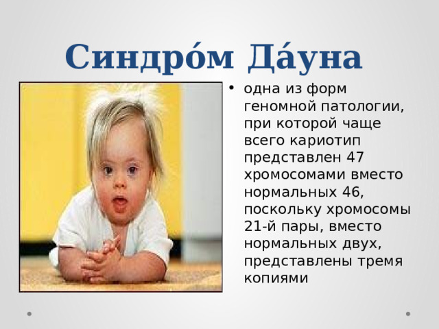 Синдро́м Да́уна   одна из форм геномной патологии, при которой чаще всего кариотип представлен 47 хромосомами вместо нормальных 46, поскольку хромосомы 21-й пары, вместо нормальных двух, представлены тремя копиями 