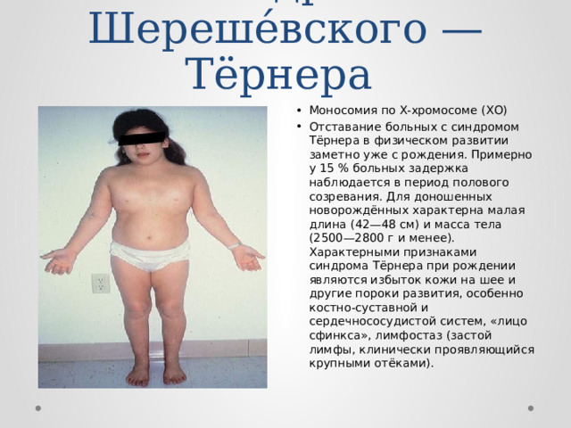 Синдро́м Шереше́вского — Тёрнера Моносомия по X-хромосоме (XО) Отставание больных с синдромом Тёрнера в физическом развитии заметно уже с рождения. Примерно у 15 % больных задержка наблюдается в период полового созревания. Для доношенных новорождённых характерна малая длина (42—48 см) и масса тела (2500—2800 г и менее). Характерными признаками синдрома Тёрнера при рождении являются избыток кожи на шее и другие пороки развития, особенно костно-суставной и сердечнососудистой систем, «лицо сфинкса», лимфостаз (застой лимфы, клинически проявляющийся крупными отёками). 