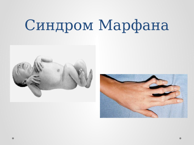 Синдром Марфана 