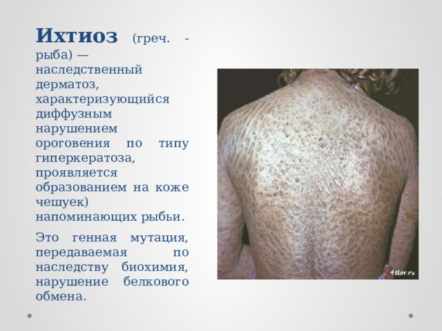 Ихтиоз  (греч. - рыба) — наследственный дерматоз, характеризующийся диффузным нарушением ороговения по типу гиперкератоза, проявляется образованием на коже чешуек) напоминающих рыбьи. Это генная мутация, передаваемая по наследству биохимия, нарушение белкового обмена. 