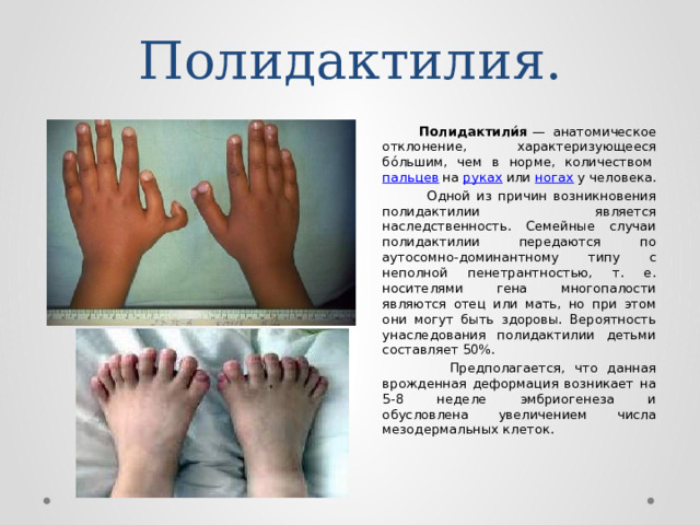 Полидактилия.  Полидактили́я  — анатомическое отклонение, характеризующееся бо́льшим, чем в норме, количеством  пальцев  на  руках  или ногах  у человека.   Одной из причин возникновения полидактилии является наследственность. Семейные случаи полидактилии передаются по аутосомно-доминантному типу с неполной пенетрантностью, т. е. носителями гена многопалости являются отец или мать, но при этом они могут быть здоровы. Вероятность унаследования полидактилии детьми составляет 50%.   Предполагается, что данная врожденная деформация возникает на 5-8 неделе эмбриогенеза и обусловлена увеличением числа мезодермальных клеток.   