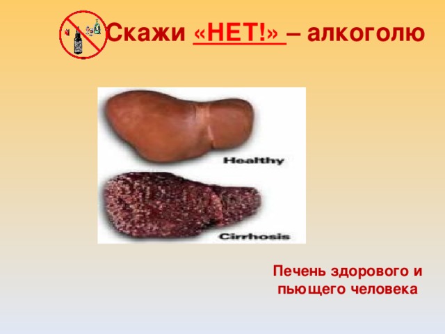 Скажи «НЕТ!» – алкоголю Печень здорового и пьющего человека  