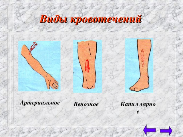 Виды кровотечений  Артериальное Венозное Капиллярное 