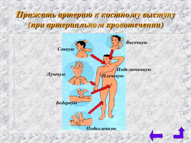 Прижать артерию к костному выступу (при артериальном кровотечении) Височную Сонную Подключичную Лучевую  Плечевую Бедерную Подколенную 