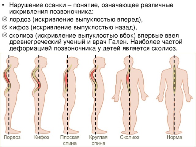 Нарушение осанки – понятие, означающее различные искривления позвоночника: лордоз (искривление выпуклостью вперед), кифоз (искривление выпуклостью назад), сколиоз (искривление выпуклостью вбок) впервые ввел древнегреческий ученый и врач Гален. Наиболее частой деформацией позвоночника у детей является сколиоз.  
