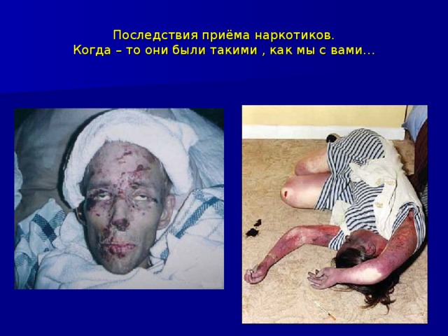 Последствия приёма наркотиков.  Когда – то они были такими , как мы с вами… 