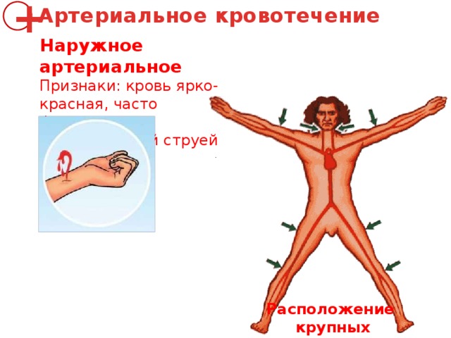 Артериальное кровотечение + Наружное артериальное Признаки: кровь ярко-красная, часто фонтанирует пульсирующей струей Расположение  крупных артерий 