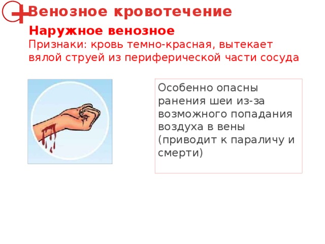 Венозное кровотечение + Наружное венозное Признаки: кровь темно-красная, вытекает вялой струей из периферической части сосуда Особенно опасны ранения шеи из-за возможного попадания воздуха в вены (приводит к параличу и смерти) 