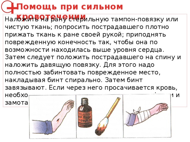 Помощь при сильном кровотечении + Наложить на рану стерильную тампон-повязку или чистую ткань; попросить пострадавшего плотно прижать ткань к ране своей рукой; приподнять поврежденную конечность так, чтобы она по возможности находилась выше уровня сердца. Затем следует положить пострадавшего на спину и наложить давящую повязку. Для этого надо полностью забинтовать поврежденное место, накладывая бинт спирально. Затем бинт завязывают. Если через него просачивается кровь, необходимо наложить дополнительные салфетки и замотать их бинтом поверх первой повязки . 
