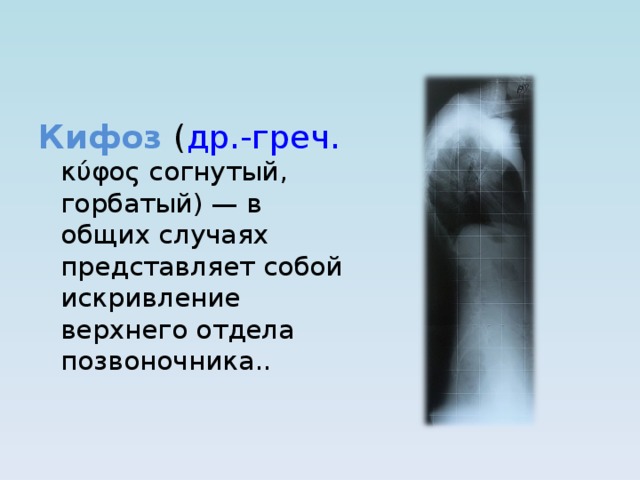 Кифоз ( др.-греч. κύφος согнутый, горбатый) — в общих случаях представляет собой искривление верхнего отдела позвоночника.. 