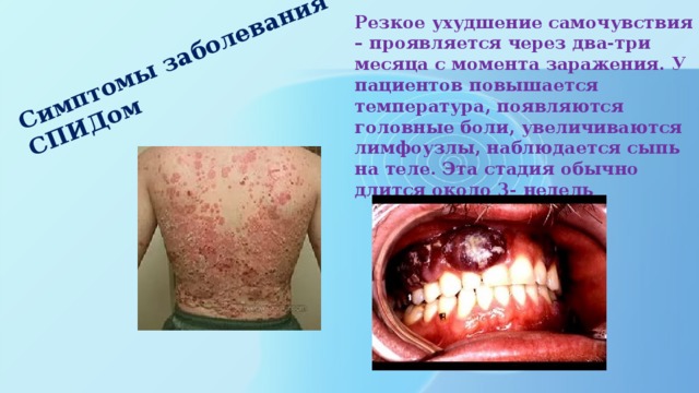 Симптомы заболевания СПИДом    Резкое ухудшение самочувствия – проявляется через два-три месяца с момента заражения. У пациентов повышается температура, появляются головные боли, увеличиваются лимфоузлы, наблюдается сыпь на теле. Эта стадия обычно длится около 3- недель    