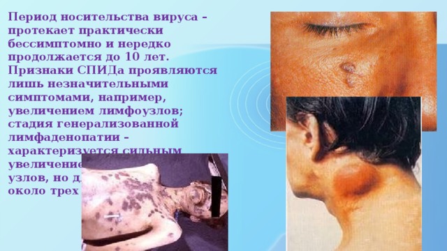 Период носительства вируса – протекает практически бессимптомно и нередко продолжается до 10 лет. Признаки СПИДа проявляются лишь незначительными симптомами, например, увеличением лимфоузлов; стадия генерализованной лимфаденопатии – характеризуется сильным увеличением лимфатических узлов, но длится недолго – около трех месяцев    