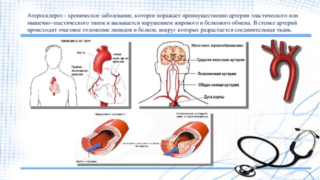 Атеросклероз - хроническое заболевание, которое поражает преимущественно артерии эластического или мышечно-эластического типов и вызывается нарушением жирового и белкового обмена. В стенке артерий происходит очаговое отложение липидов и белков, вокруг которых разрастается соединительная ткань. 