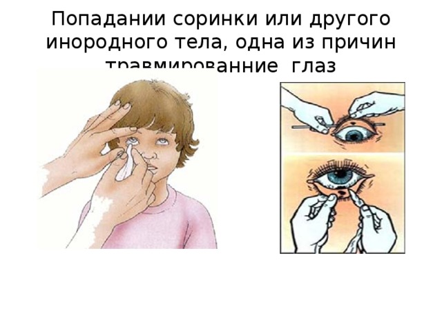 Попадании соринки или другого инородного тела, одна из причин травмированние глаз 
