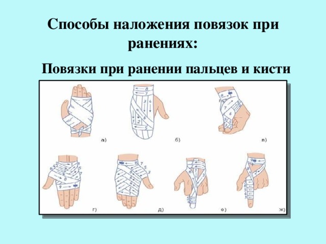 Способы наложения повязок при ранениях:  Повязки при ранении пальцев и кисти 