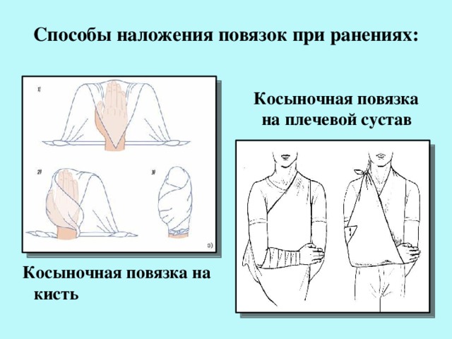 Способы наложения повязок при ранениях:  Косыночная повязка на плечевой сустав  Косыночная повязка на кисть 