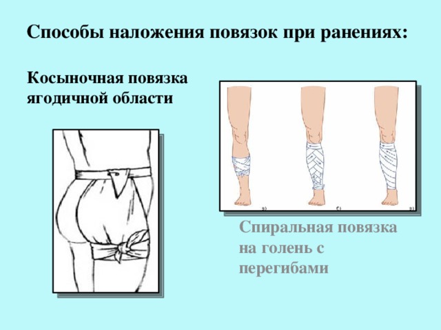 Способы наложения повязок при ранениях: Косыночная повязка ягодичной области Спиральная повязка на голень с перегибами 